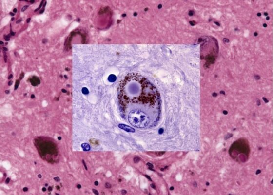 Parkinson Cuerpos Lewy