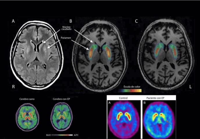 Parkinson neuroimagen
