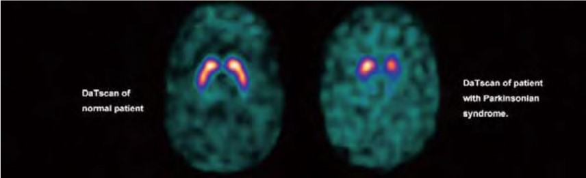 Parkinson vs cerebro normal