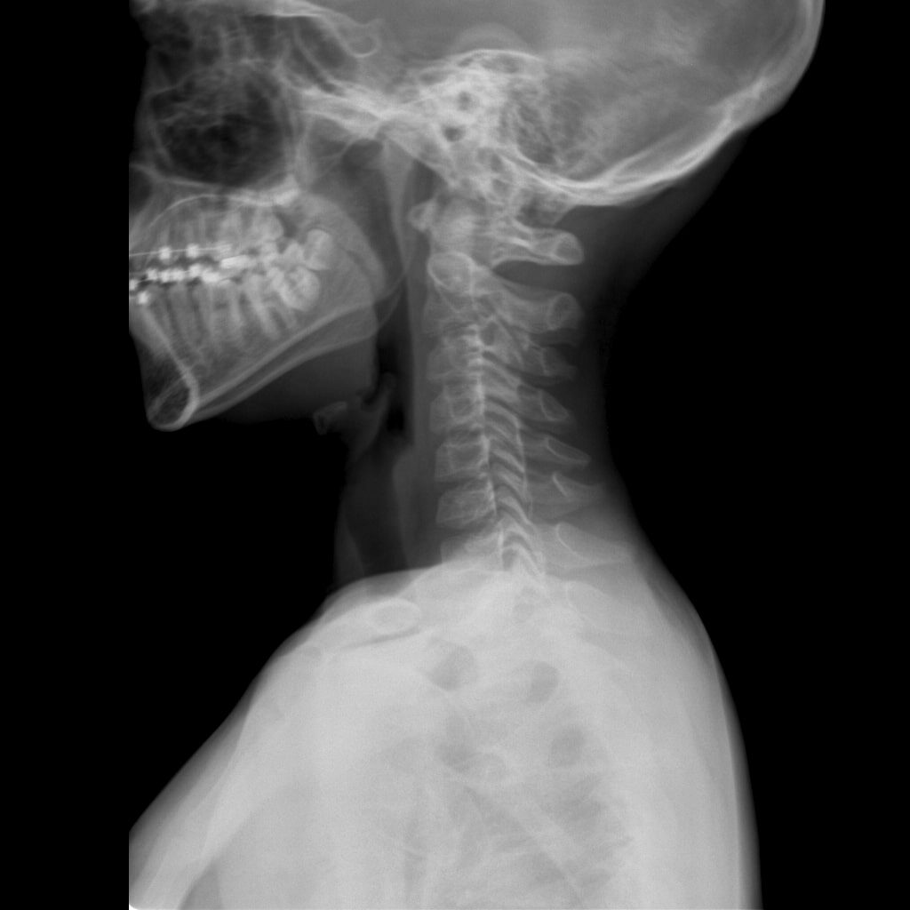 Columna vertebral Cervical