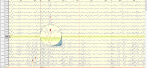 Epilepsia Cartografía