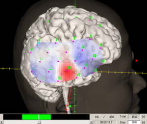 Epilepsia Topografia