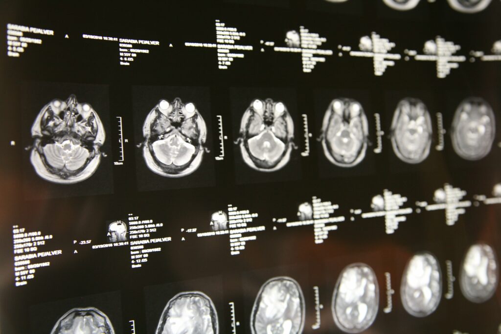 Una serie de imágenes de resonancia magnética cerebral mostradas en un panel retroiluminado, que muestran múltiples imágenes transversales con distintos detalles de las estructuras cerebrales. Etiquetas de texto blancas y escalas de medición acompañan cada imagen.
