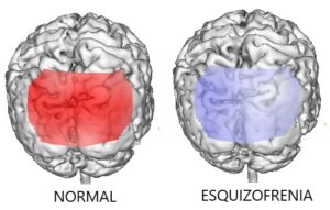 Topografía Esquizofrenia_Respuesta anómala a estímulo luminoso
