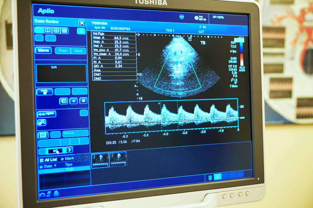 Un monitor médico muestra una imagen de ultrasonido en color y datos de forma de onda relacionados con un examen cardíaco, mostrando varias mediciones y configuraciones en la pantalla, cruciales para evaluar tanto la salud del corazón como los posibles vínculos con enfermedades cerebrovasculares.