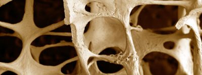 Osteoporosis